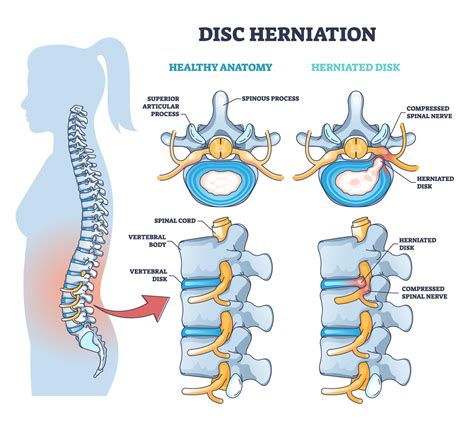 Herniated Disc Treatment in Frisco | DRX9000 Spinal Decompression