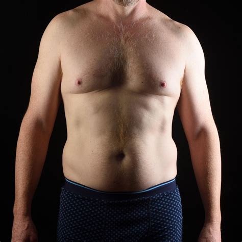 Male Chest Reduction | Willis Cosmetic Surgery | Gynecomastia St. Louis