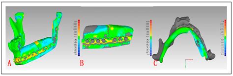 Outcome Evaluation of Three-Dimensionally Printed Patient-Specific ...