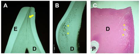 Dental Manifestations and Oral Management of X-Linked Hypophosphatemia