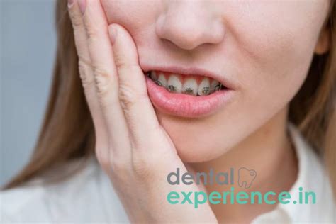 Invisible braces cost in India- Transparent teeth braces