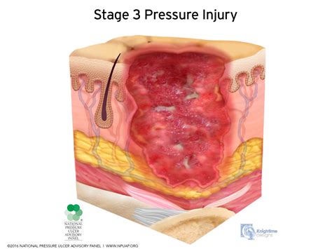 Pressure Injuries - Physiopedia