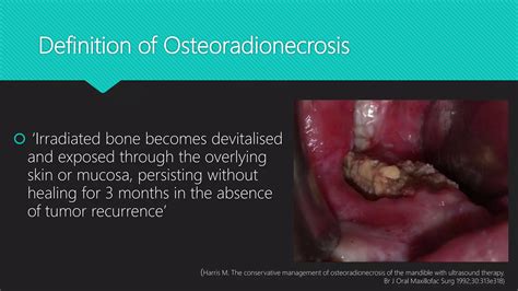 Osteoradionecrosis | PPTX