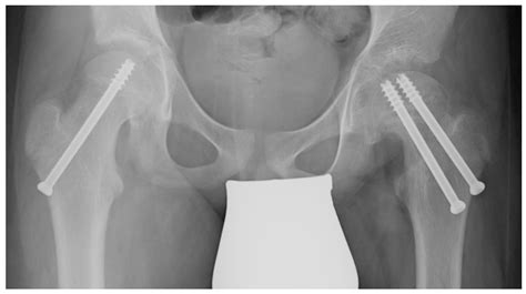 The Medium- to Long-Term Results of Vascular-Sparing Subcapital ...