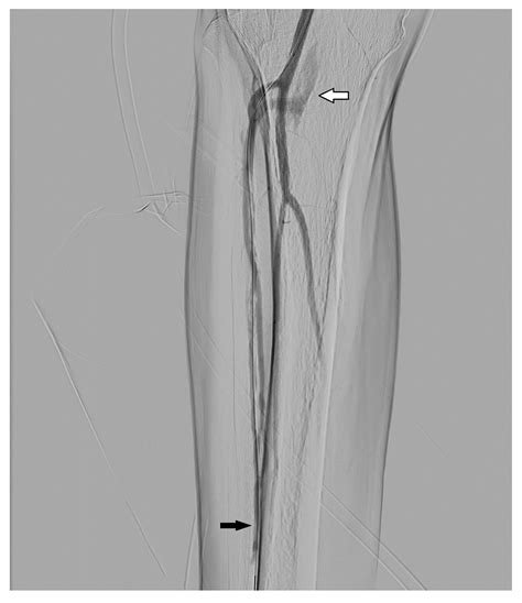 Digital Subtraction Angiography (DSA) Technical and Diagnostic Aspects in the Study of Lower ...