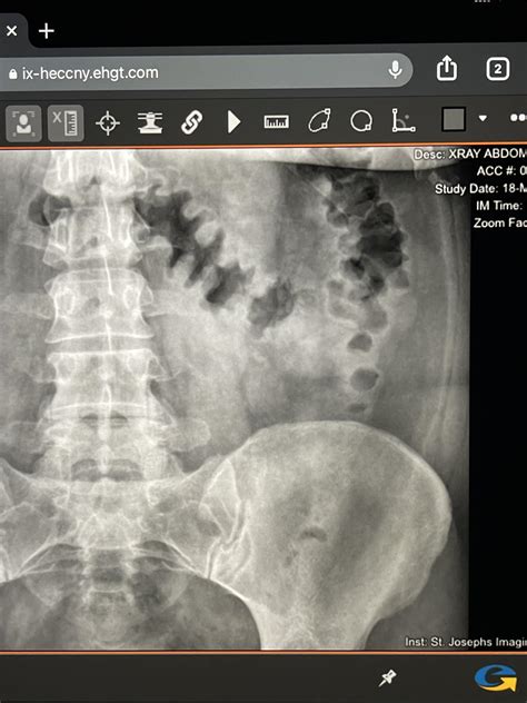 Moderate Colonic Stool Burden