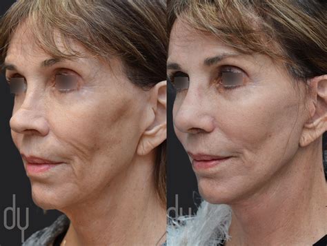 Before and After Deep Plane Facelift to lift and tighten the jawline and neckline. A deep plane ...