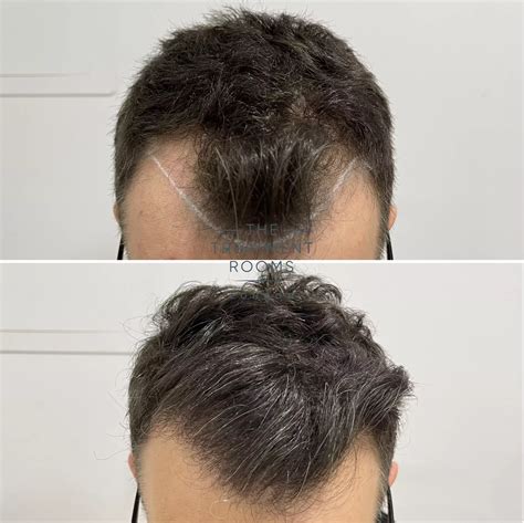 Mature Hairline Vs. Receding Hairline: What’S The Difference – JZIPJK