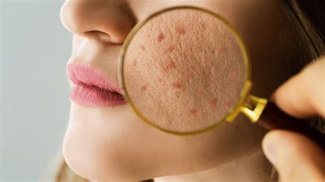 How to Stop Skin Purging Immediately: Best Tips and Solutions.