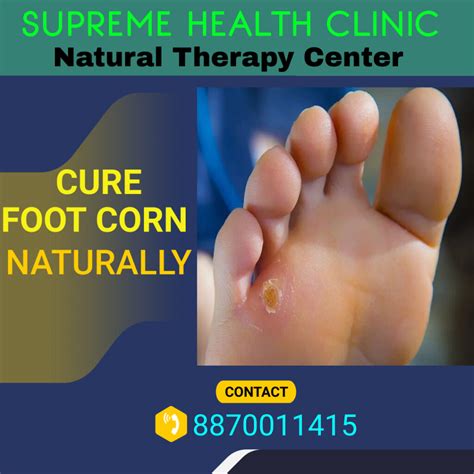 Treating Foot Corns Naturally at Karen Medina blog