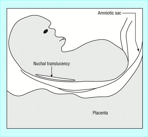 Using fetal nuchal translucency to screen for major congenital cardiac ...