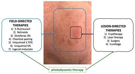 Topical Photodynamic Therapy with Different Forms of 5-Aminolevulinic ...