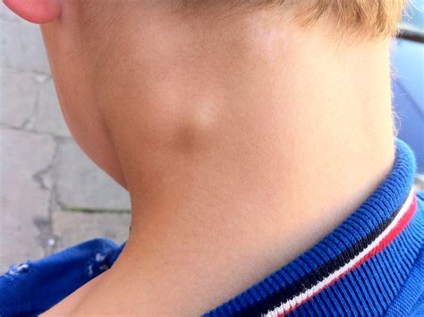 Lump in the Neck: Causes, Symptoms, Treatments and More! | MD-Health.com