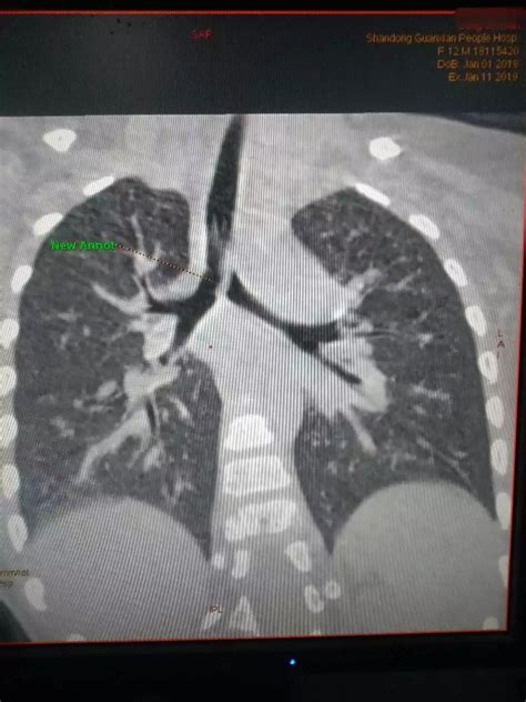 医学科普‖气管CT三维重建，精准显示气管异物及气道相关病变_影像
