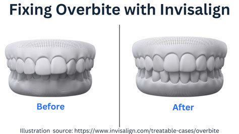 Braces For Overbite Process at Douglas Nunez blog