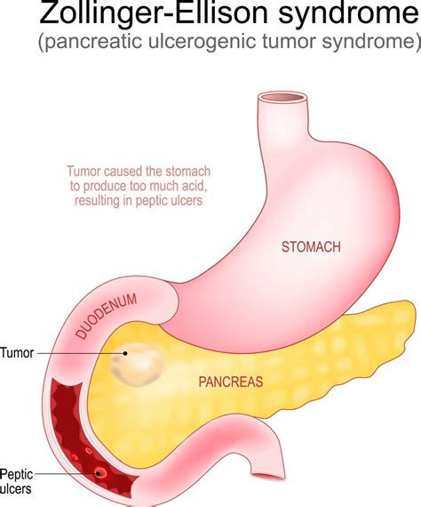 Zollinger-Ellison Syndrome (ZES) | Pharmacology Mentor