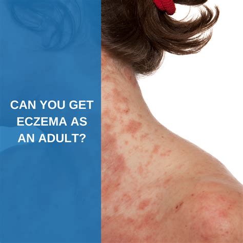 Can You Get Eczema as an Adult? - Savannah River Dermatology