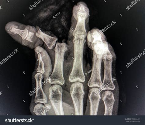 Open Fracture Index Finger Joint Dislocation Stock Photo 1749658481 ...