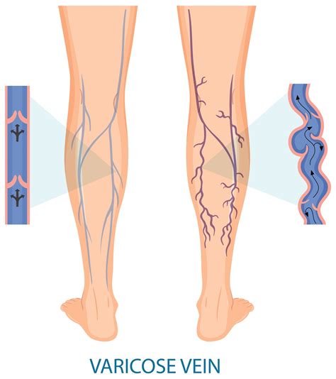 What Causes Varicose (Spider) Veins? - A2Z Healthy