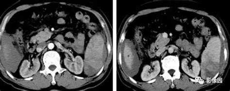 脾臟破裂CT病例圖片影像診斷分析！ - 每日頭條