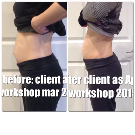 Cost of diastasis recti surgery - fessfrenzy