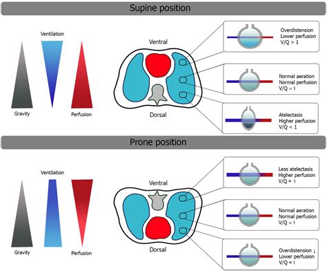 JCM | Free Full-Text | Prone Positioning and Molecular Biomarkers in COVID and Non-COVID ARDS: A ...