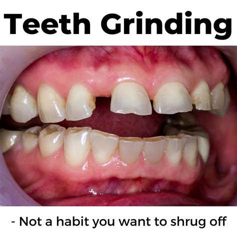 Image result for teeth grinding