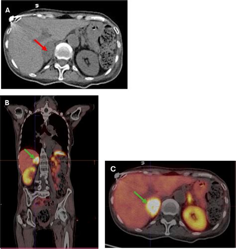 Frontiers | Case report: Pheochromocytoma-induced pseudo-Cushing’s syndrome