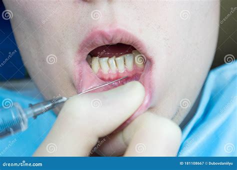 Infiltration Anesthesia Dental Lower 的图像结果