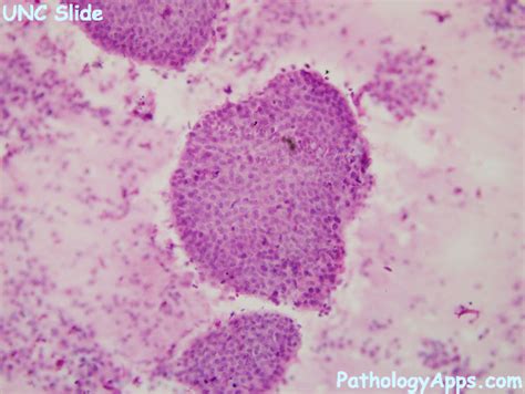 Kuvatulokset haulle brunner syndrome