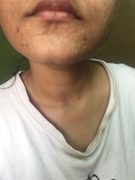 What are these bumps on my chin? They get itchy sometime. Some days ...