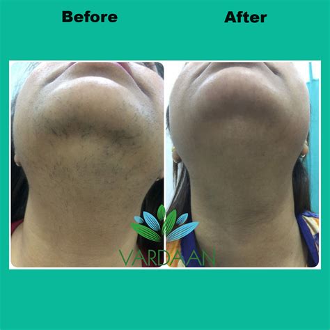 Laser Hair Removal Clinic in Delhi, Full Body Laser Hair Removal Cost in Delhi - Vardaan Clinic