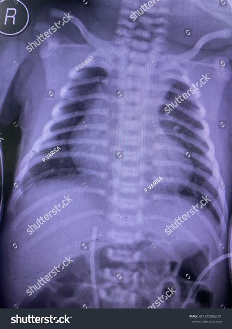 Tetralogy Of Fallot X Ray