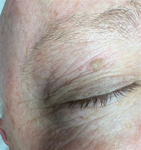 Seborrheic Keratosis on the Face Removal