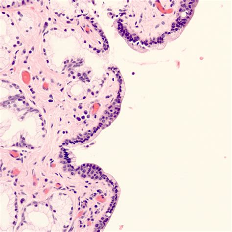 Pathology Outlines - Vulvovaginal cysts