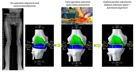 Functional Alignment Philosophy in Total Knee Arthroplasty—Rationale ...