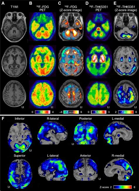 18F-THK5351 positron emission tomography imaging for Gerstmann ...
