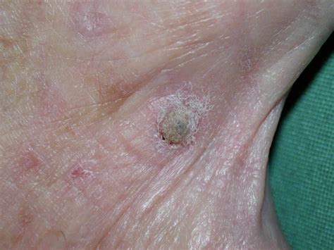 Actinic Keratosis