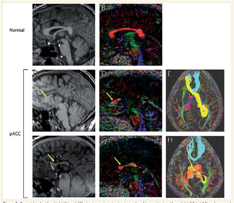 Agenesis of corpus callosum | Semantic Scholar