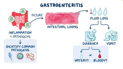 Infectious gastroenteritis: Video & Meaning | Osmosis