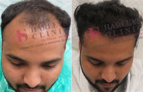 How Many Grafts Do You Need for a Natural Hair Density?
