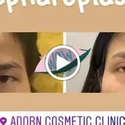 ADORN Cosmetic Clinic Ahmedabad, Gynecomastia liposuction hair ...