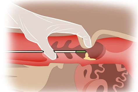 Praxis-Tutorial: Die Besamung einer Kuh in 3 Schritten | agrarheute.com