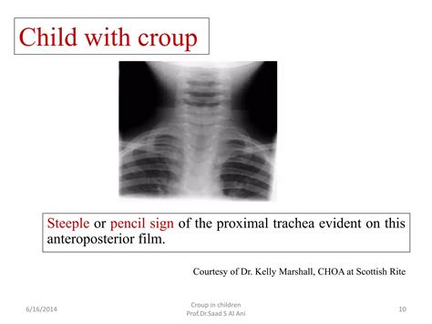 Croup in children | PPTX