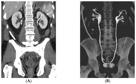 Complications Subsequent to Urinary Tract Stent Placement: An Overview Focusing on the Imaging ...