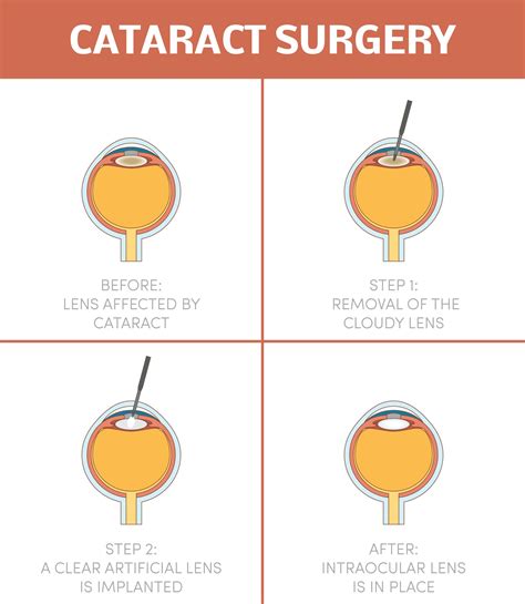 Cataract Surgery Process Cataract Surgery | Private Cataract Removal