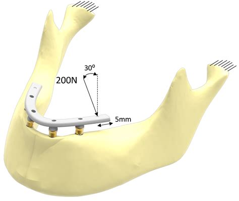Implant-Supported Prostheses in the Edentulous Mandible: Biomechanical ...