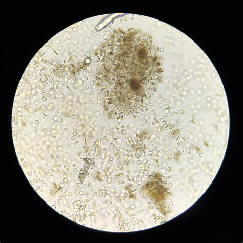 Bilirubin Crystal In Urine