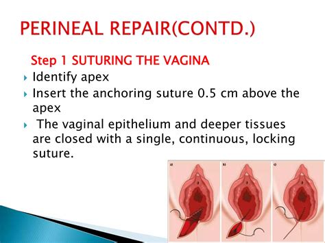EPISIOTOMY AND ITS REPAIR.pptx