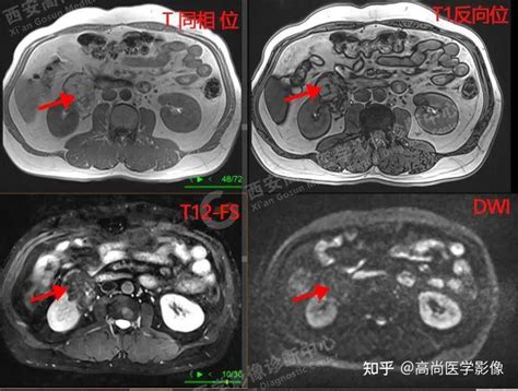 18F-FDG PET/CT联合MR诊断肾脏血管平滑肌脂肪瘤一例【高尚医学影像】 - 知乎